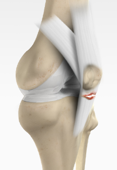 Tendon Injuries
